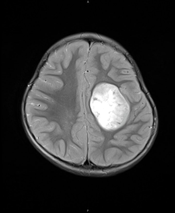 轴位 T2 MRI
