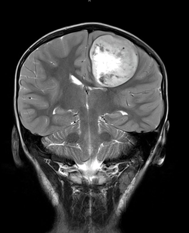 冠状位 T2 MRI