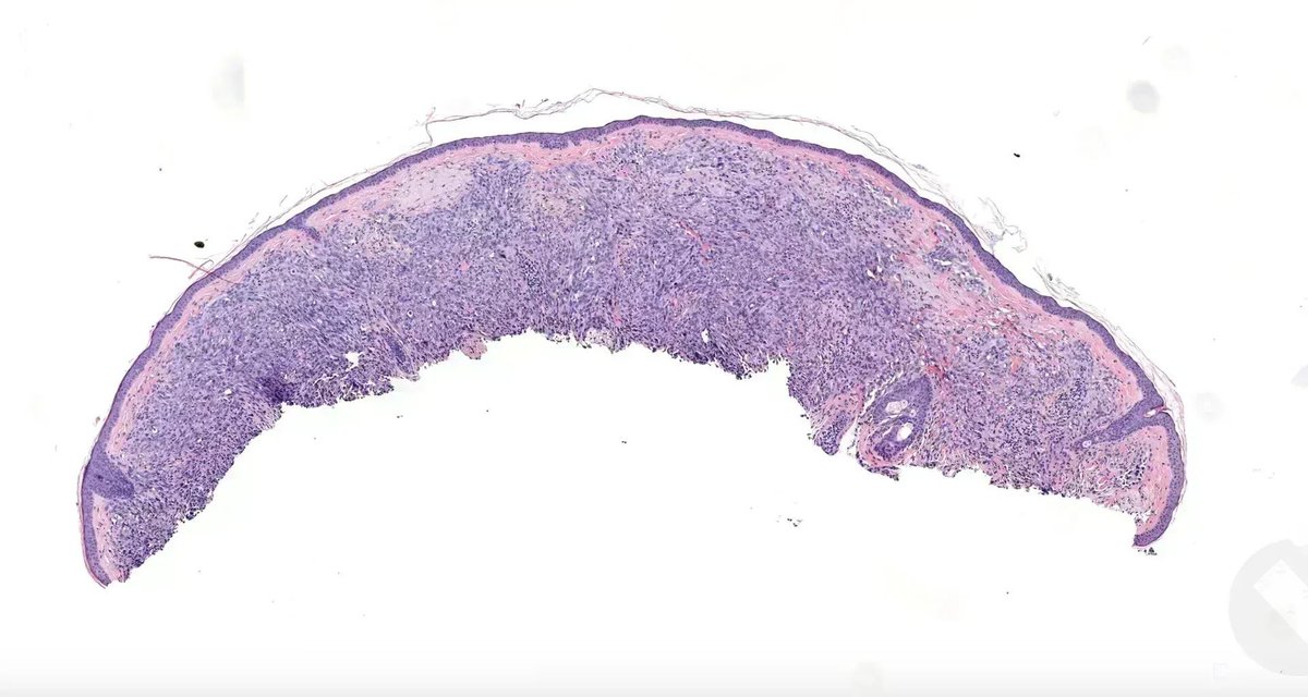 CD34阴性血管肉瘤镜下图1